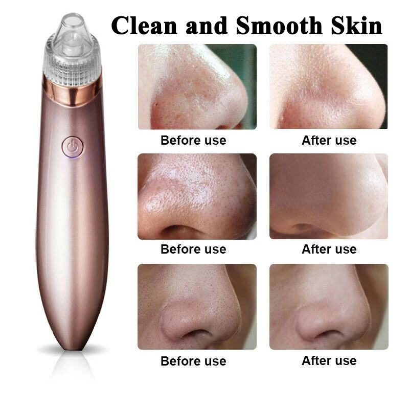 Blackhead Remover